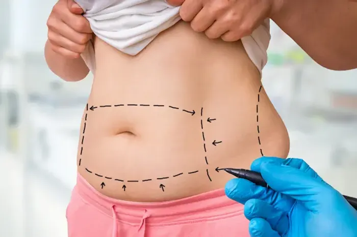 Liposuction Surgery: Key Benefits, Risks & Recovery